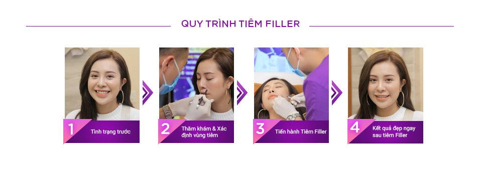 Các bước tiêm filler an toàn và hiệu quả